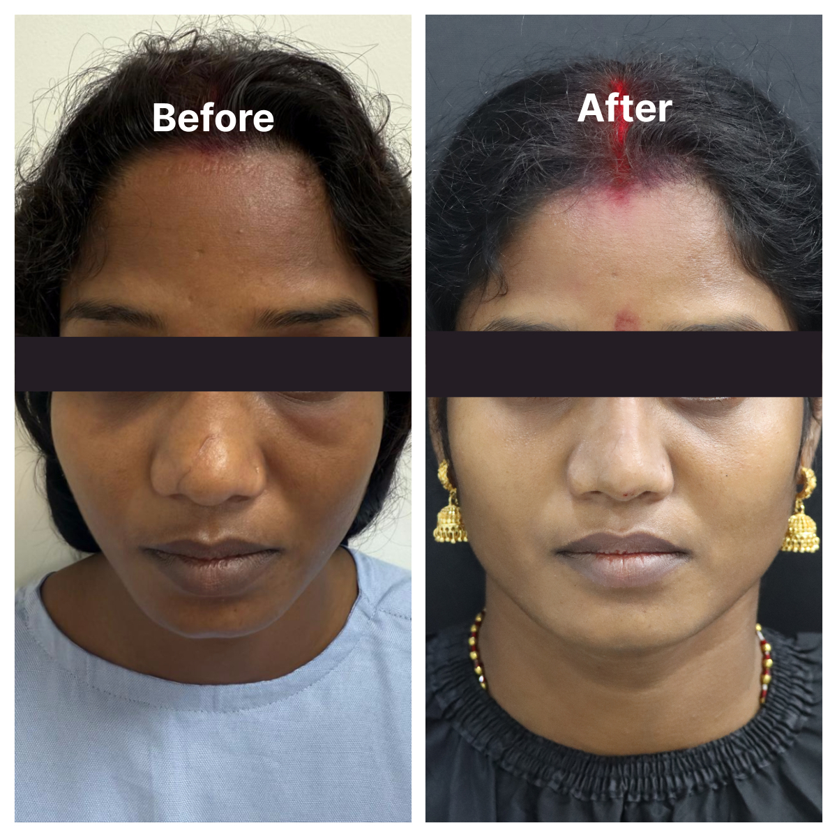 Alar Reduction result KOQ10